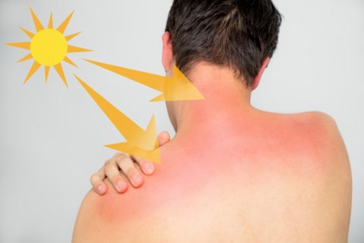 Kako se spopasti s sončnimi opeklinami?