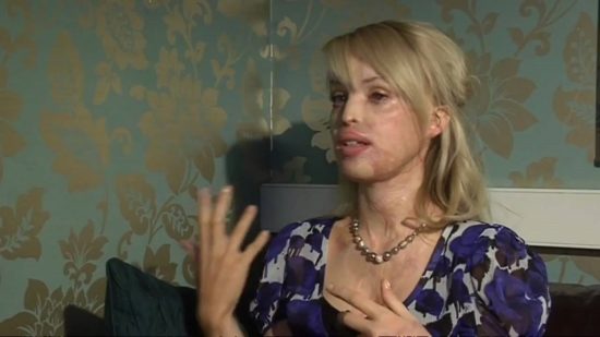 V Veliki Britaniji se vsak teden zgodi 15 napadov s kislino