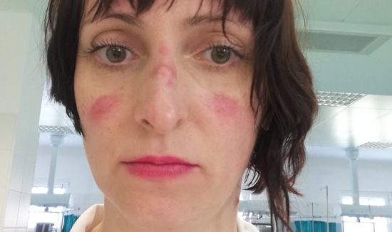Zdravnica, ki je zdravila bolnika, domnevno okuženega s koronavirusom, po štirih urah in pol snela masko: “Vam to kaj pove? Meni pove”