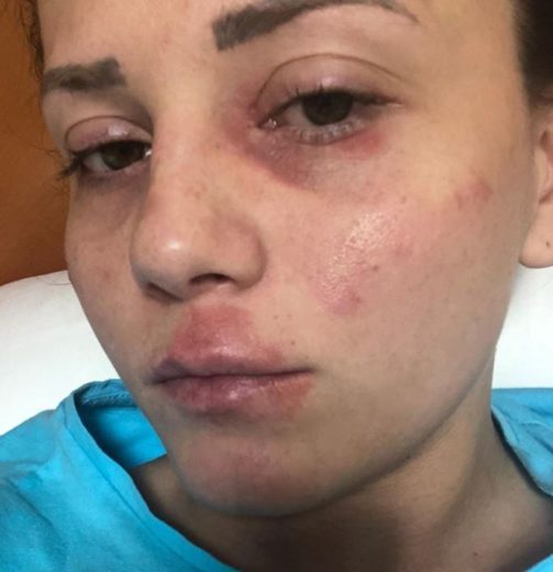 Slovenska športnica objavila fotografijo, kaj takega ni pričakoval nihče: V takšnem stanju sem že pet mesecev