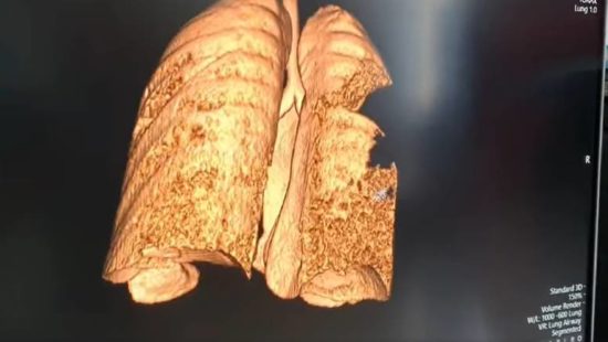 Pulmolog pokazal pljuče mladeniča s Covid-19: To je popolno uničenje tkiva